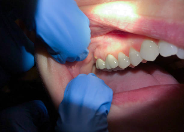 Best Emergency Dental Care for Abscessed Tooth in Lockport, IL